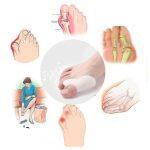 Férula de Silicona para Corregir los Dedos de los Pies - Imagen 6